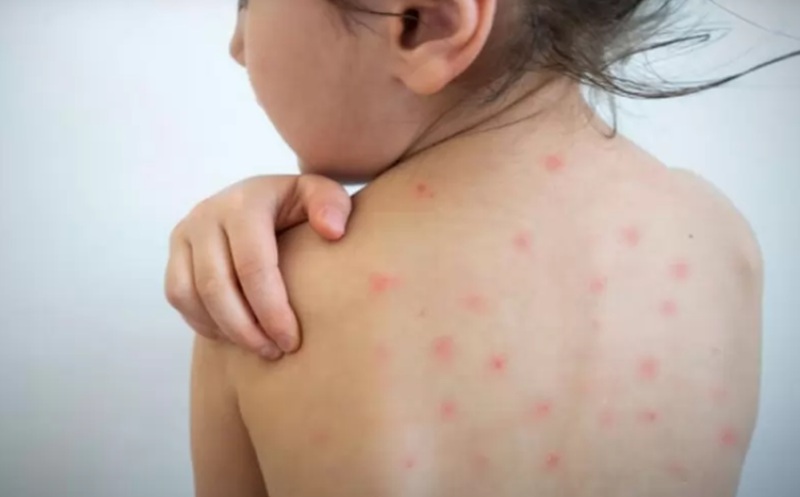 Случаите на морбили в България нараснаха до 101