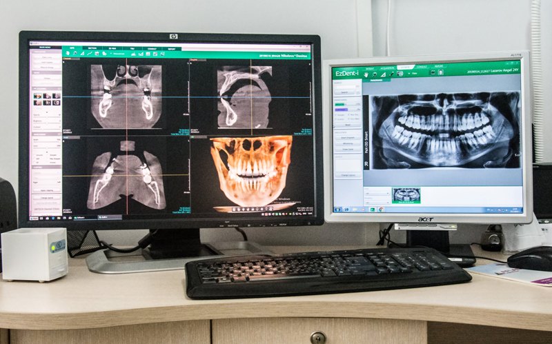 Най-новата 3D диагностика в Бургас в помощ при зъбните импланти 